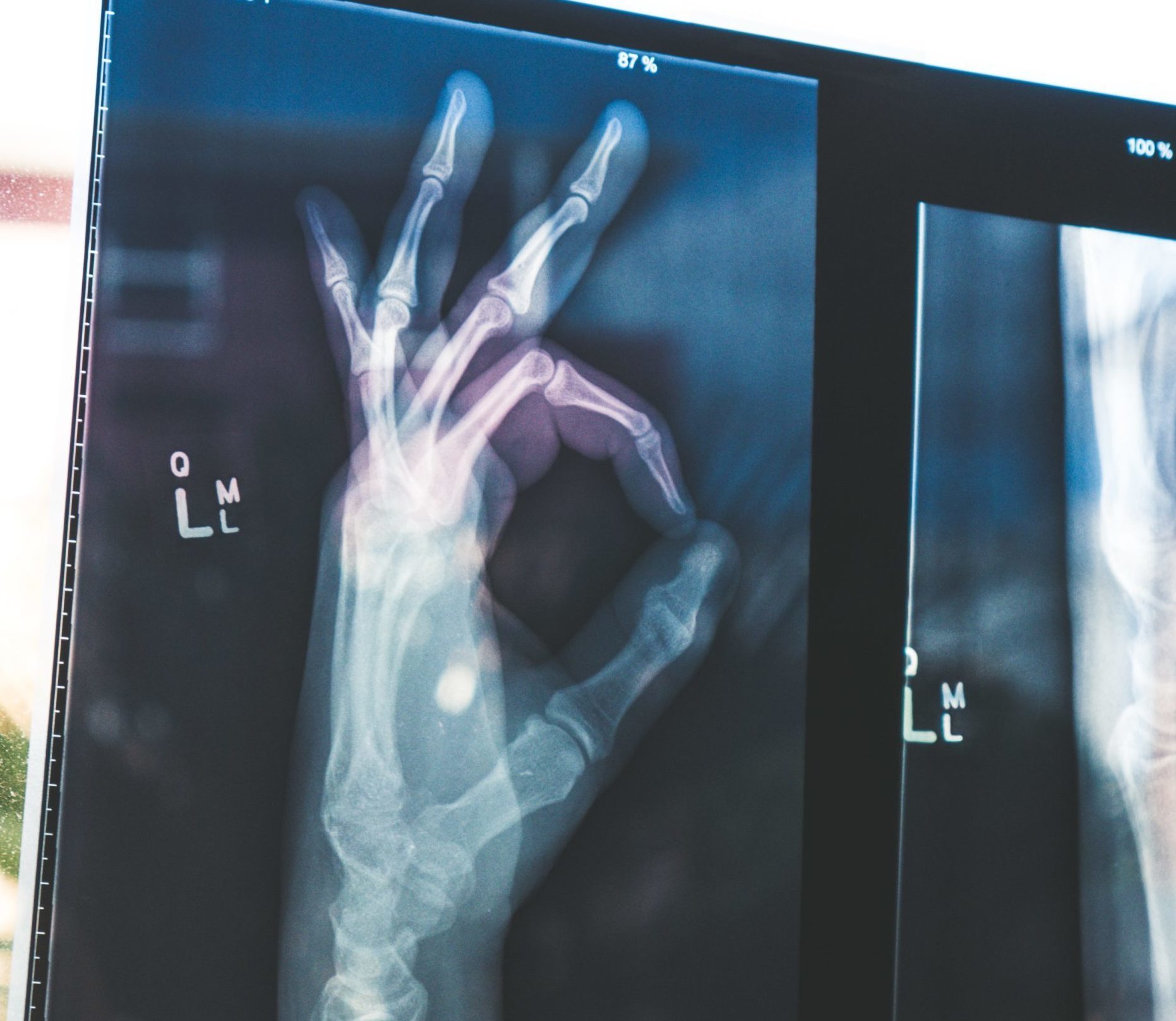 xray of left hand giving ok sign