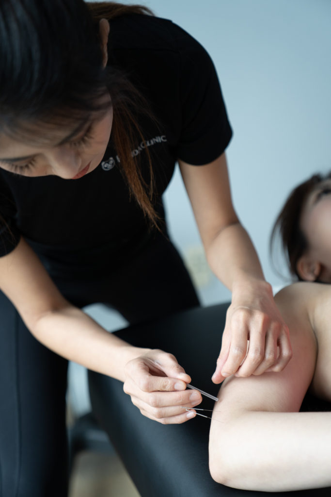 acupuncturist placing needle into woman's arm