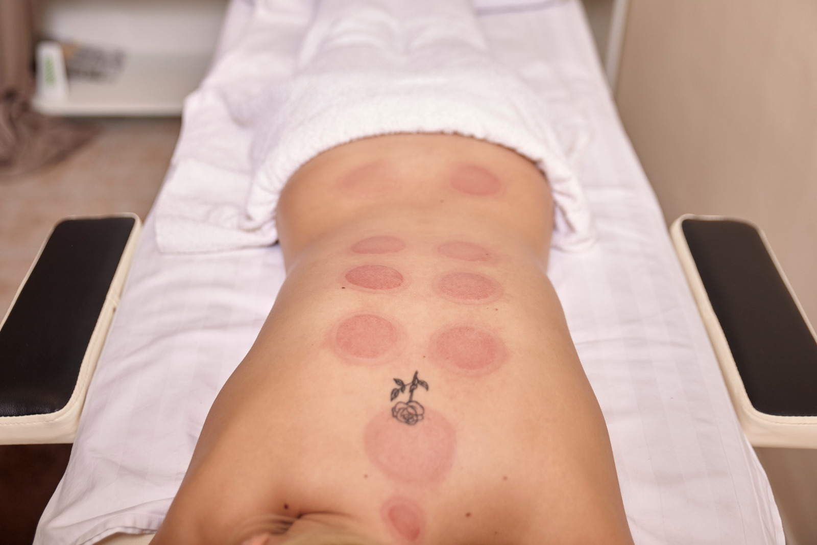 red vacuum spots, dry cupping therapy, on woman back.