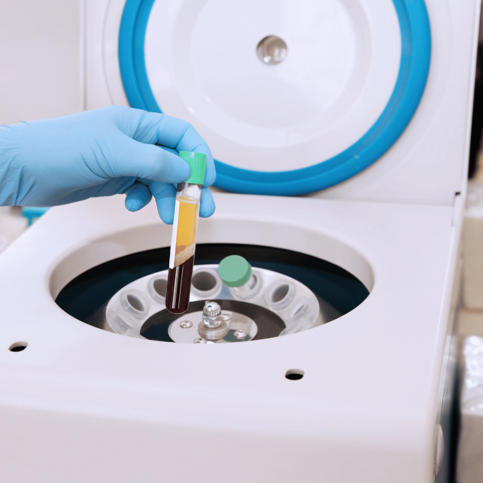 A close-up photo showing a person's hand wearing a blue glove, holding a test tube filled with a yellowish liquid layered over red liquid in front of a PRP machine. The machine is mostly white with some blue details. PRP, which stands for Platelet-Rich Plasma, is often used to help heal burns and injuries. The lab is very clean and has equipment that spins the blood to separate the parts. This helps get the PRP ready for doctors to use.