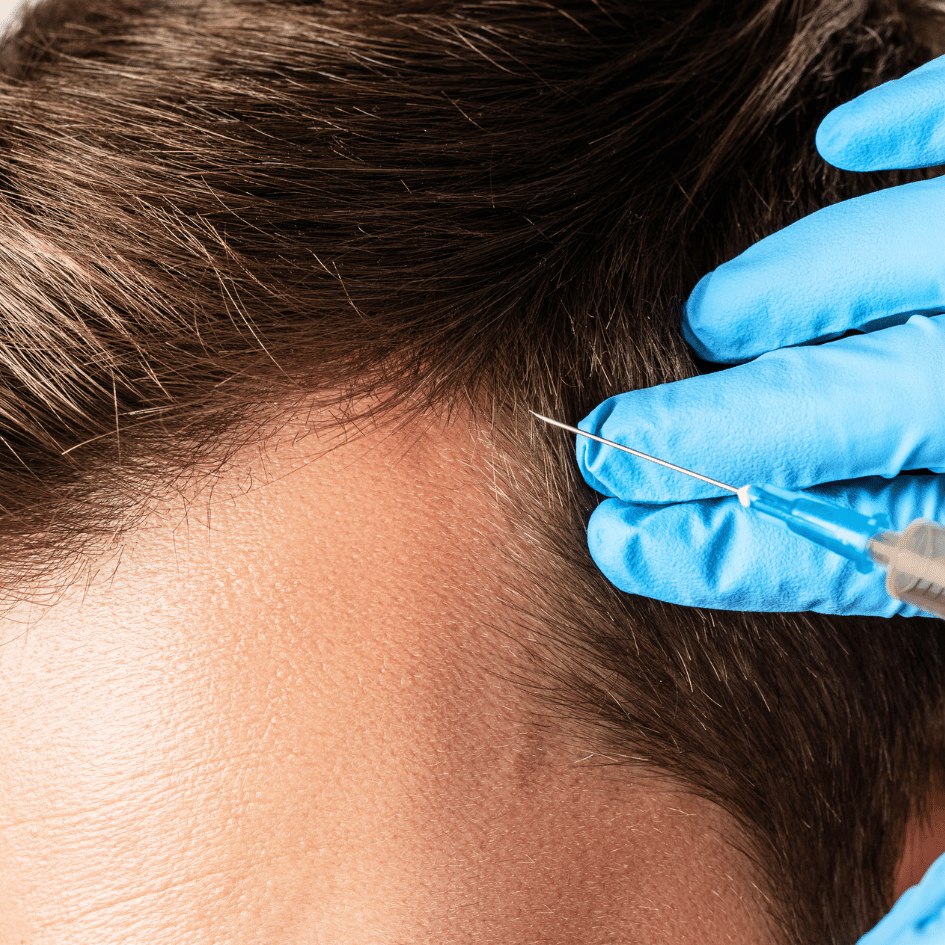 In this close-up picture, we see a person getting PRP therapy. You can see the person's skin and short, dark hair. A doctor with blue gloves is holding a small needle very close to the person's head. The needle is part of the PRP therapy, which helps people in many ways, like making hair strong and healthy. The blue gloves are the kind that doctors wear, and the needle is really thin. Everything else is blurry, so we focus on the PRP therapy happening. This kind of therapy uses a special part of the blood to help the body. The photo helps us see how doctors do PRP therapy carefully.