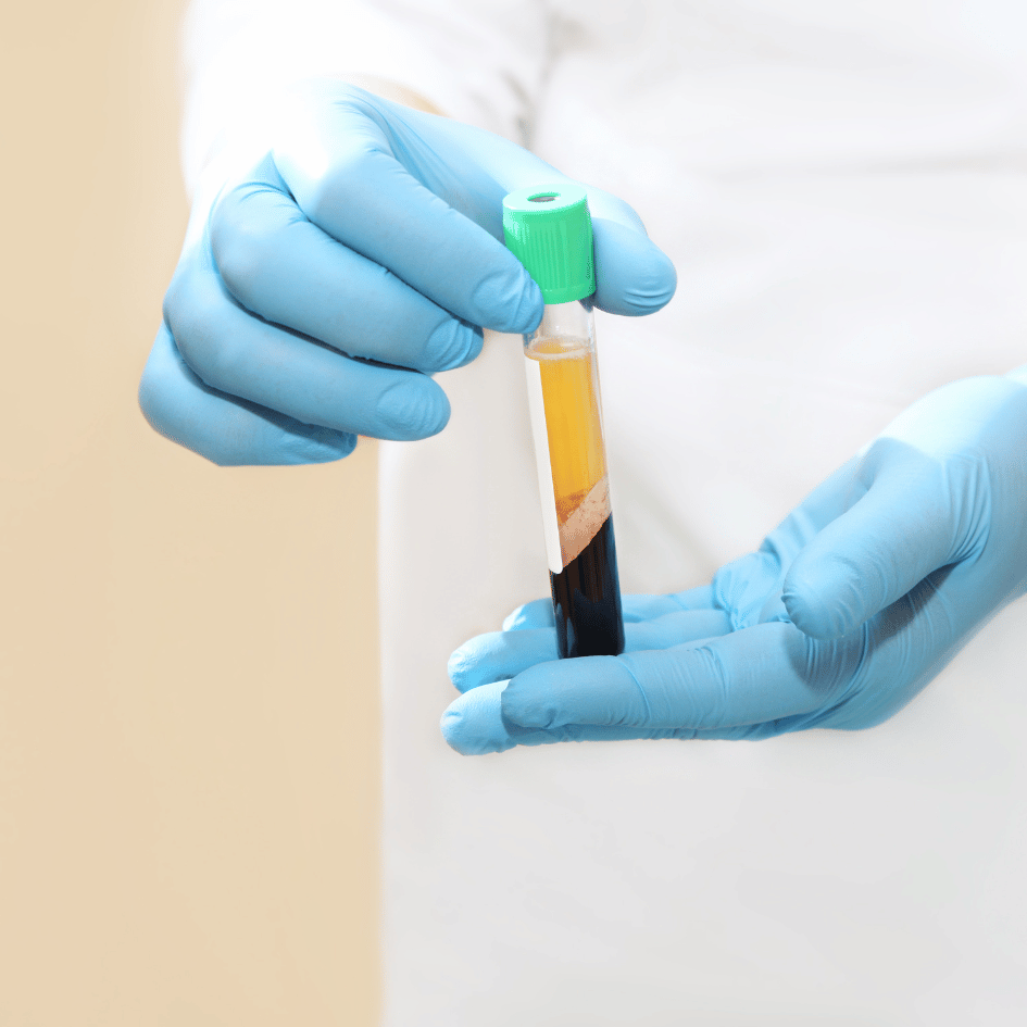 In the picture, we see a person wearing a white coat and blue gloves holding a test tube. The test tube has a green cap and two different colors inside: the top is a light yellow, and the bottom is dark red. This is how PRP therapy starts. PRP means Platelet-Rich Plasma, and that's the yellow part at the top. It's used by doctors to help our bodies heal from injuries or operations. The red part is the rest of the blood. The hands are holding the tube carefully, and the background is light and not too busy, so we can really see the colors in the tube. This shows us a part of what happens in PRP therapy.