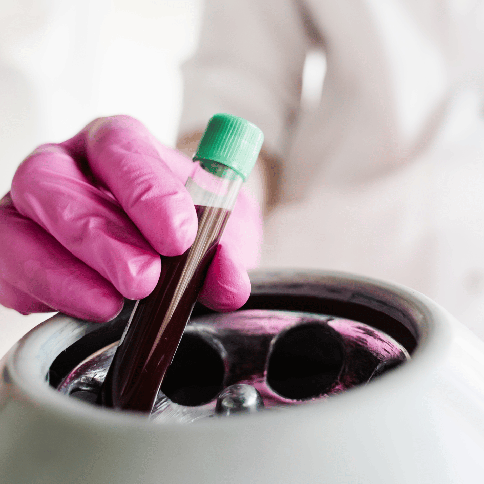 In this photo, we see a hand with pink gloves holding a test tube with a green cap. The tube is filled with a dark red liquid and is being placed into a machine with round openings, which is likely a centrifuge used in PRP therapy. The centrifuge machine spins the blood to separate the platelet-rich plasma from the rest of the blood. This process is important in PRP therapy because it helps collect the healing parts of the blood. The person in the white coat with the pink gloves is doing this task carefully. The machine and the test tube are the main things we can see, with a clean, white background that keeps our focus on the PRP therapy process.