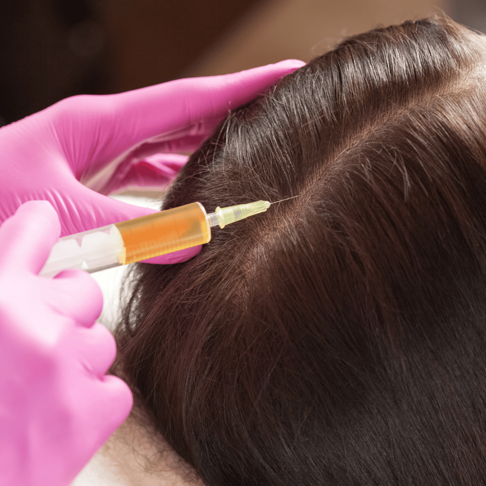 A close-up picture shows someone's head with dark brown hair. A hand in a pink glove is holding a syringe that's touching the scalp. The syringe has a golden-yellow liquid inside, which is likely to be PRP, short for Platelet-Rich Plasma. PRP therapy is used to help hair grow and to heal. The hand in the pink glove is careful and gentle, showing that PRP therapy is a safe and focused treatment. The background is dark, making it easy to see the details of the person's hair and the syringe used in PRP therapy.